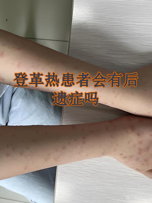 祁阳登革热疫情最新消息