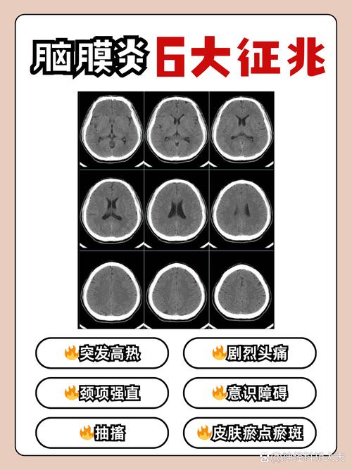 颍泉症,一种预防性脑病的常见表现,值得警惕