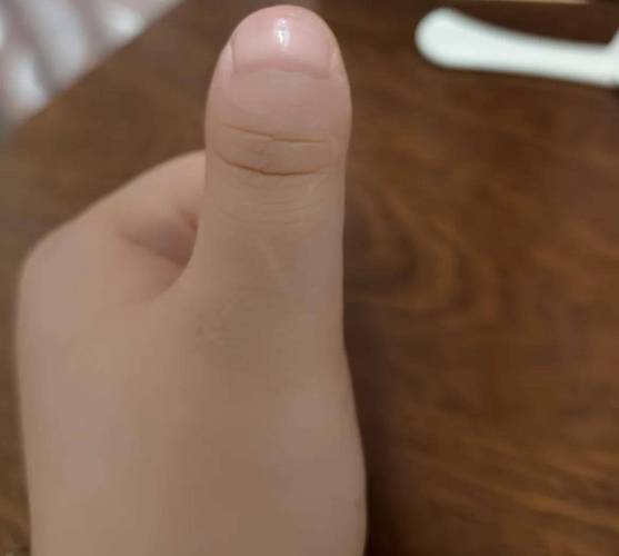 计算器辐射斑，一个令人困惑的健康谜题